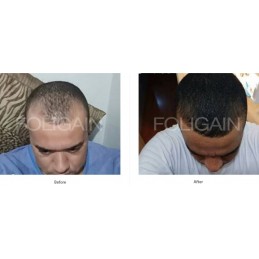 Foligain Minoxidil 5% Solutie – Cresterea parului la barbati, alcool scazut, pachet 3 luni Foligain Minoxidil 5% soluție este un