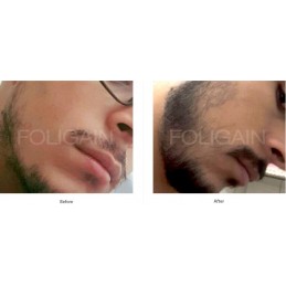 Foligain Minoxidil 5% Solutie – Cresterea parului la barbati, alcool scazut, pachet 3 luni Foligain Minoxidil 5% soluție este un