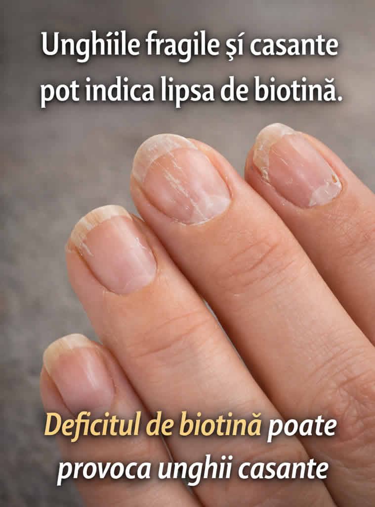 Unghii fragile și exfoliate asociate cu deficit de biotină și lipsa vitaminei B7