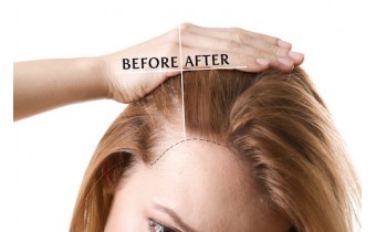 Minoxidil solutie 2% - Metoda regenerare par femei?